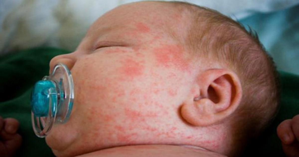 Στρεπτόκοκκος Α: Τι είναι, πώς μεταδίδεται και πως θα το αντιμετωπίσετε